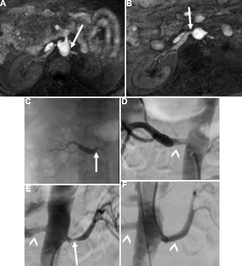 (A and B) Bilateral severe renal artery stenosis in an elderly hypertensive male with chronic kidney disease detected on unenhanced renal magnetic resonance angiography study, 80-90 per cent stenosis in the left main renal artery and 70-80 per cent stenosis in right main renal artery (arrows). (C-F) Findings confirmed on digital subtraction angiography, 90 per cent - right renal artery stenosis and 80 per cent left renal artery stenosis (arrows), and bilateral renal artery stenting done (arrowheads).